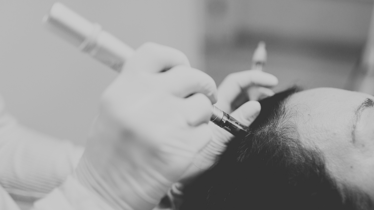 How effective is Microneedling for Hair Growth?