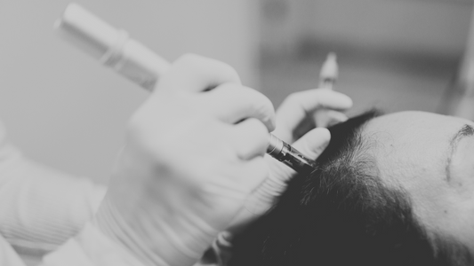 How effective is Microneedling for Hair Growth?