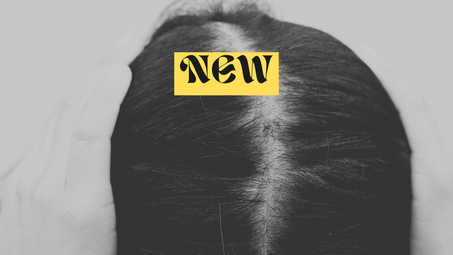 Should I Start Minoxidil for Hair Loss?